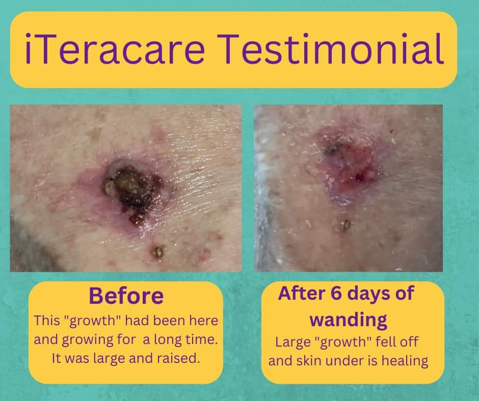 Terahertz Wand Testimonial 71 Year Old Gets Feeling Back in Foot and Toes  and Sees Reduction